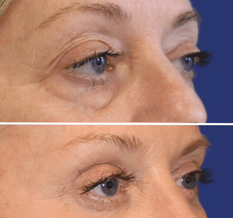 blefaroplastia