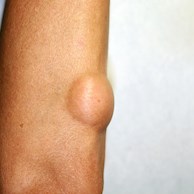 lipoma_remoçao