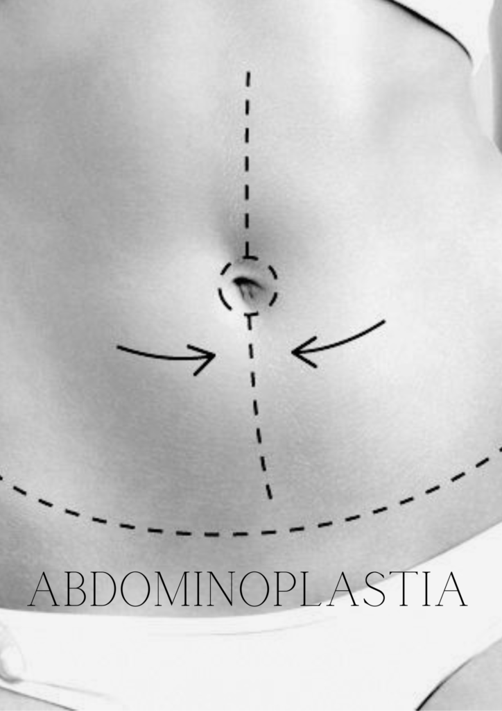 abdominoplastia