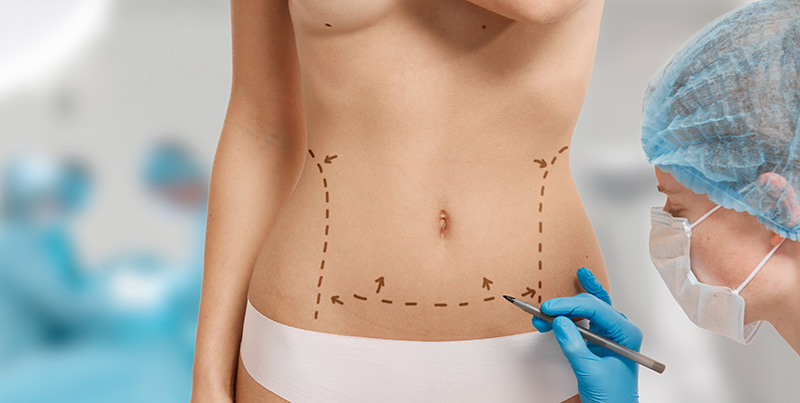 abdominoplastia