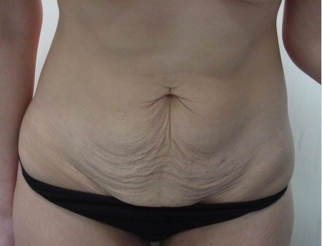 Flacidez na barriga